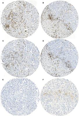 High immune cell infiltration predicts improved survival in cholangiocarcinoma